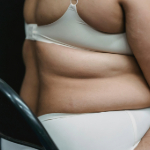 obesidad piel thumbnail_es